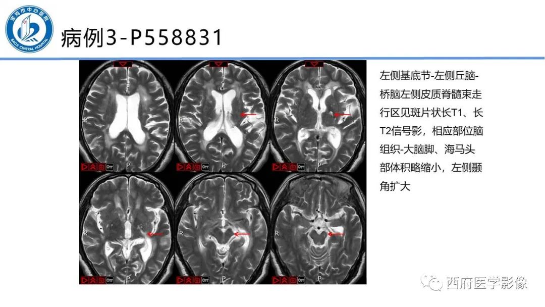 影像PPT - 【PPT】华勒氏变性的影像诊断-22