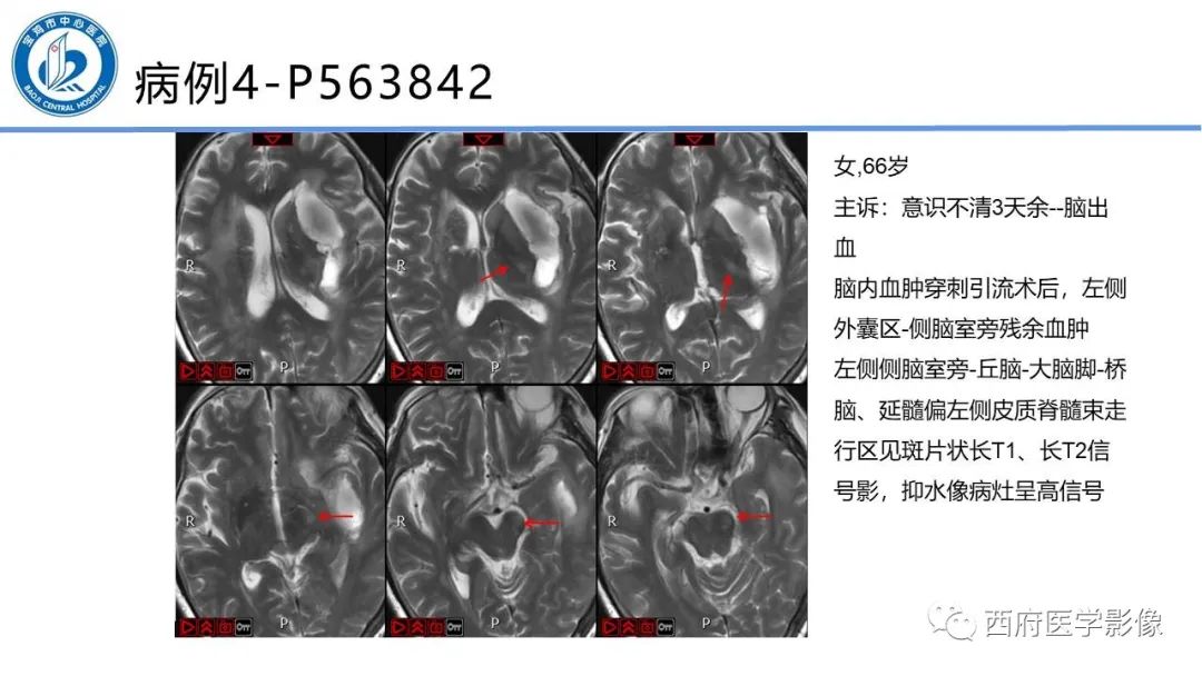 影像PPT - 【PPT】华勒氏变性的影像诊断-25