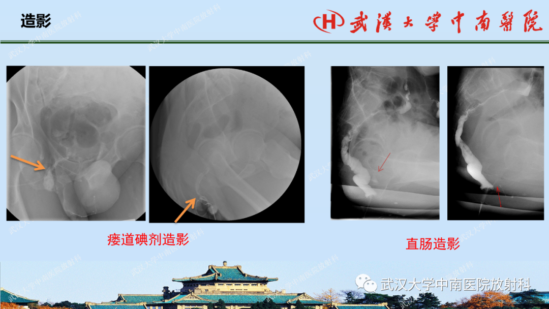 影像PPT - 【PPT】肛瘘及肛周感染病变的影像诊断-7