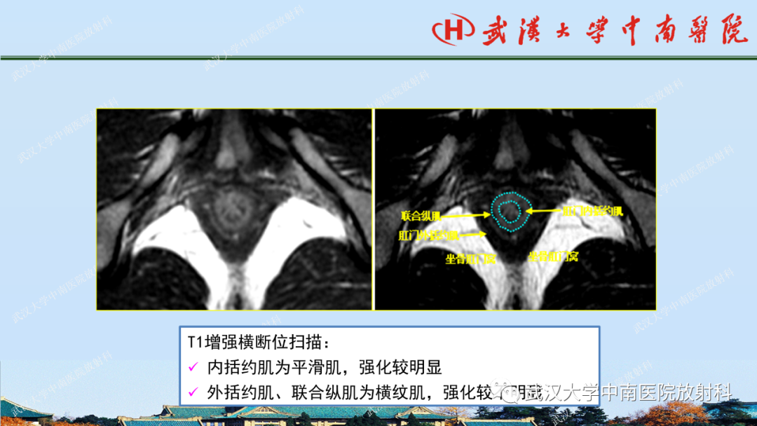 影像PPT - 【PPT】肛瘘及肛周感染病变的影像诊断-11