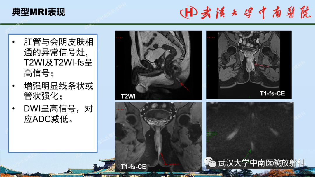影像PPT - 【PPT】肛瘘及肛周感染病变的影像诊断-14