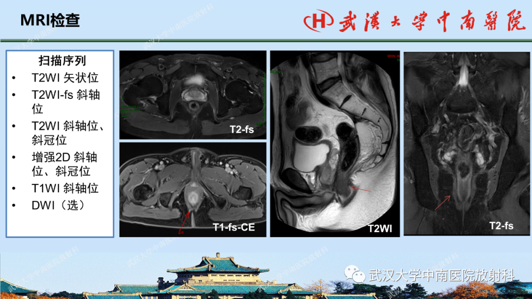 影像PPT - 【PPT】肛瘘及肛周感染病变的影像诊断-10