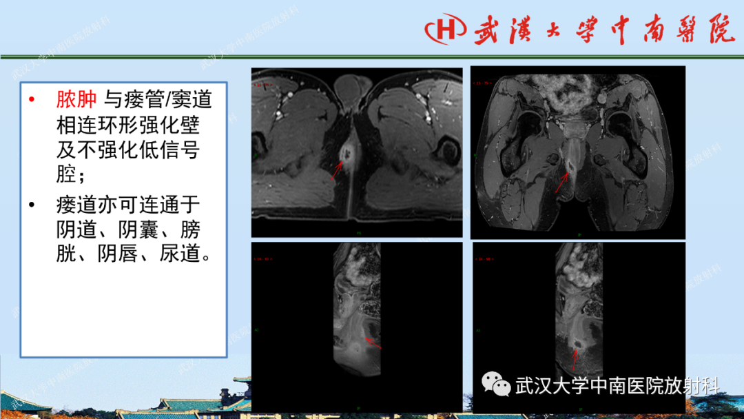 影像PPT - 【PPT】肛瘘及肛周感染病变的影像诊断-15