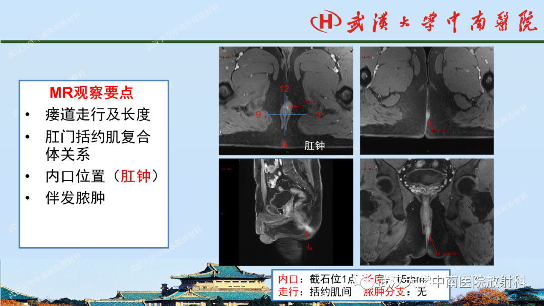 影像PPT - 【PPT】肛瘘及肛周感染病变的影像诊断-16