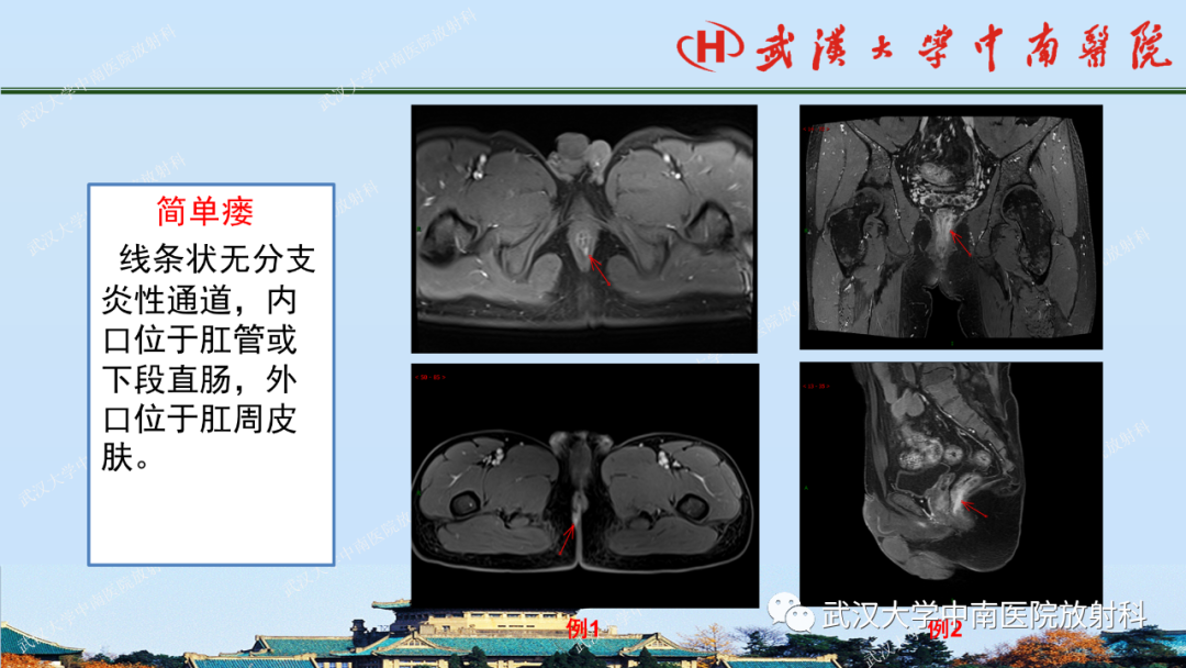 影像PPT - 【PPT】肛瘘及肛周感染病变的影像诊断-17