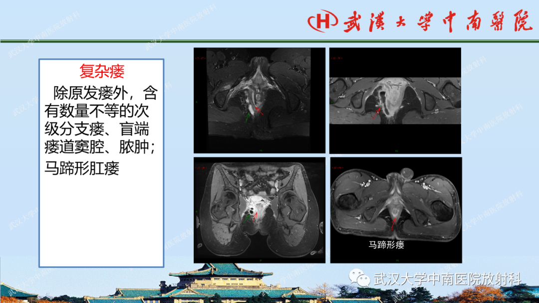 影像PPT - 【PPT】肛瘘及肛周感染病变的影像诊断-18