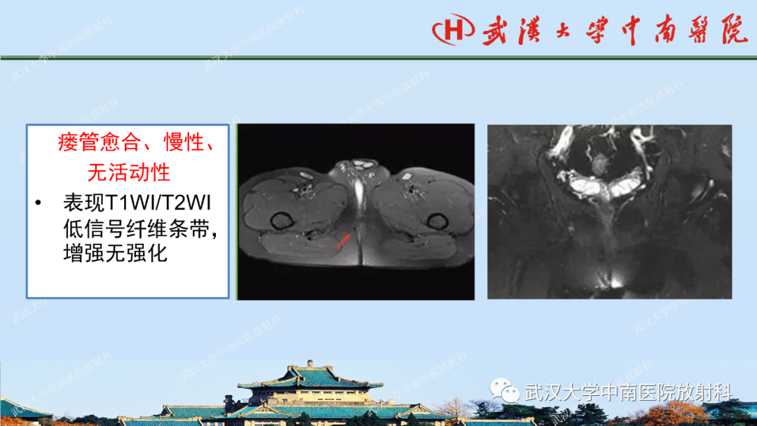 影像PPT - 【PPT】肛瘘及肛周感染病变的影像诊断-19