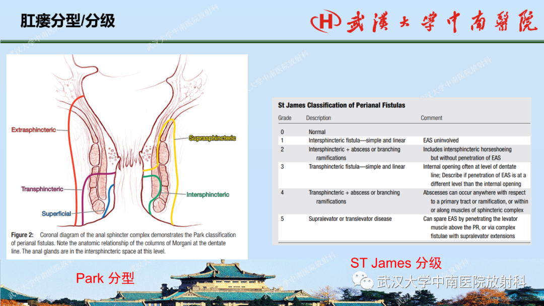 影像PPT - 【PPT】肛瘘及肛周感染病变的影像诊断-20