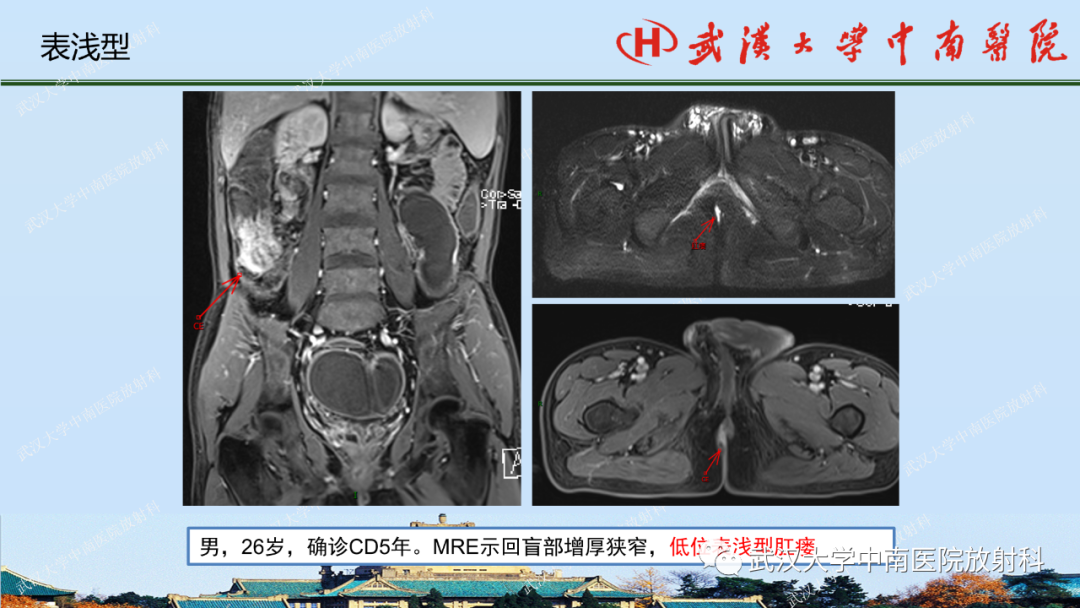 影像PPT - 【PPT】肛瘘及肛周感染病变的影像诊断-21