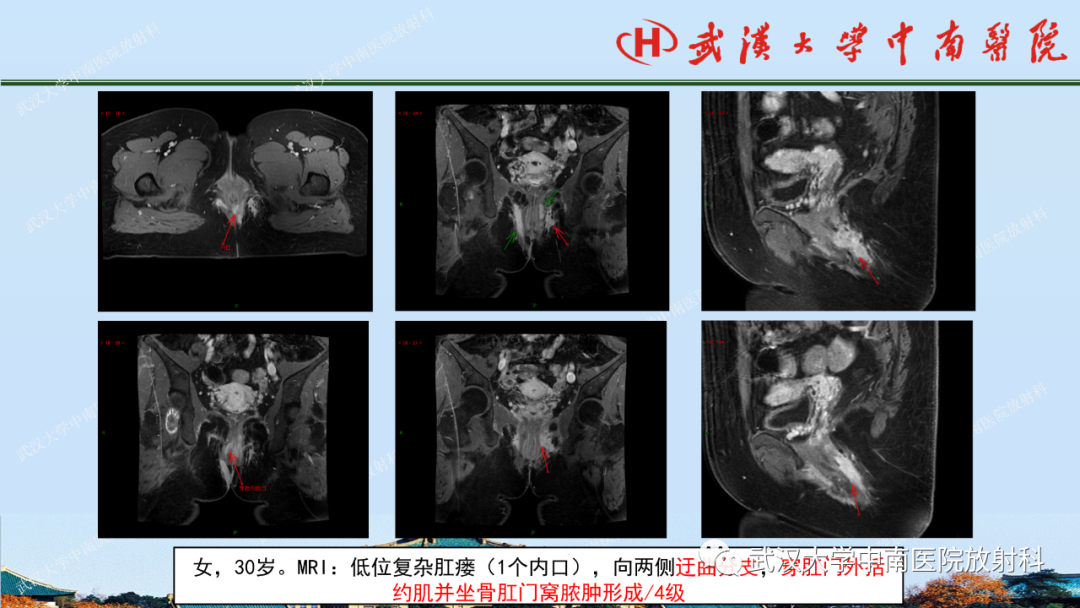 影像PPT - 【PPT】肛瘘及肛周感染病变的影像诊断-24