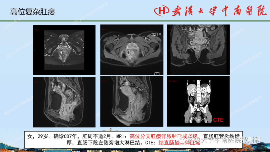 影像PPT - 【PPT】肛瘘及肛周感染病变的影像诊断-26