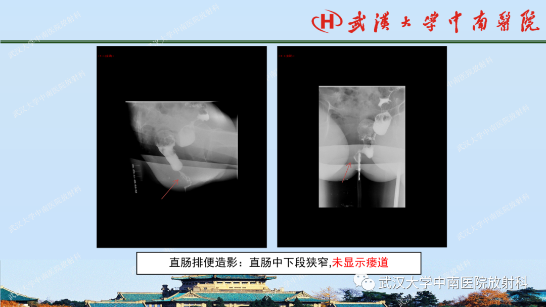 影像PPT - 【PPT】肛瘘及肛周感染病变的影像诊断-27