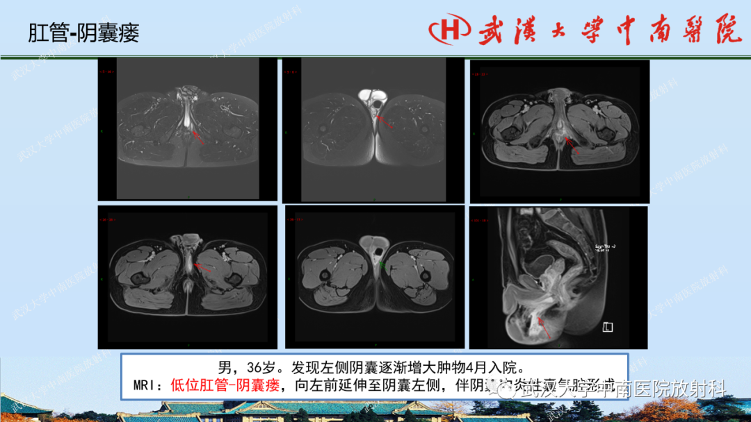 影像PPT - 【PPT】肛瘘及肛周感染病变的影像诊断-28