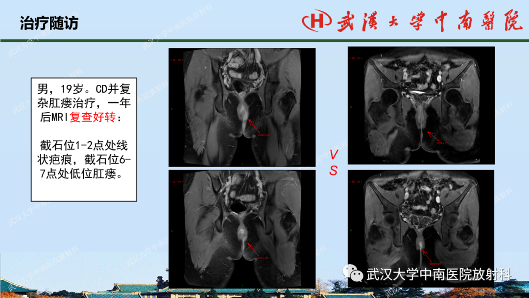 影像PPT - 【PPT】肛瘘及肛周感染病变的影像诊断-29