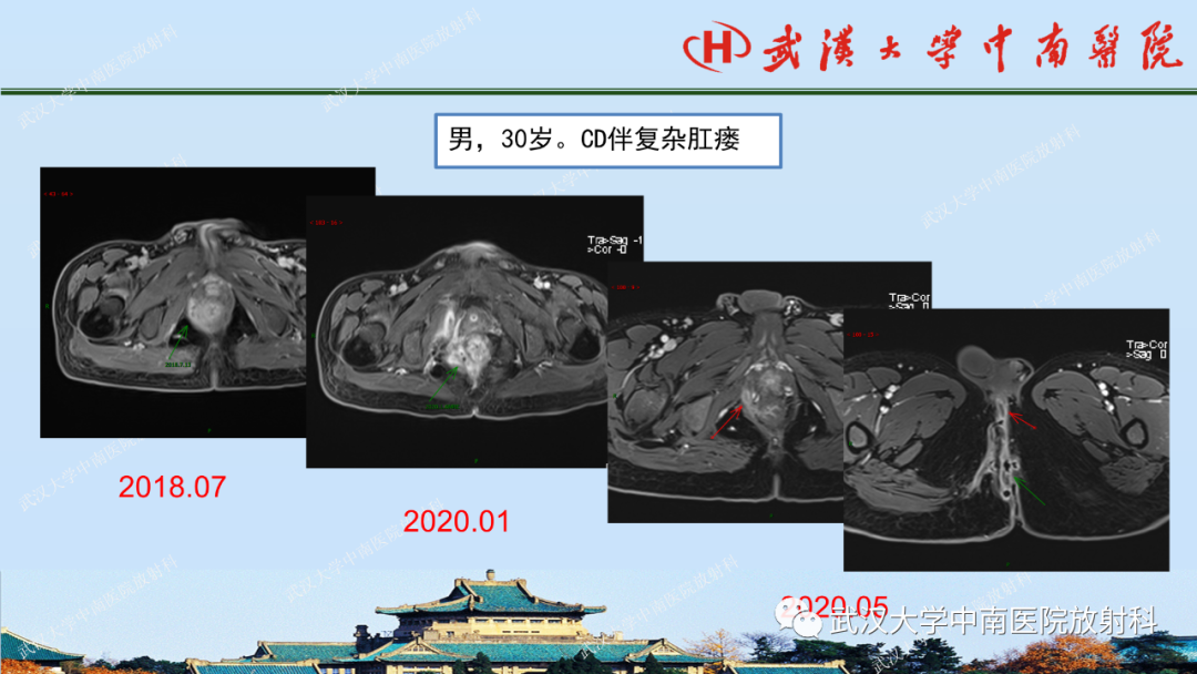 影像PPT - 【PPT】肛瘘及肛周感染病变的影像诊断-30