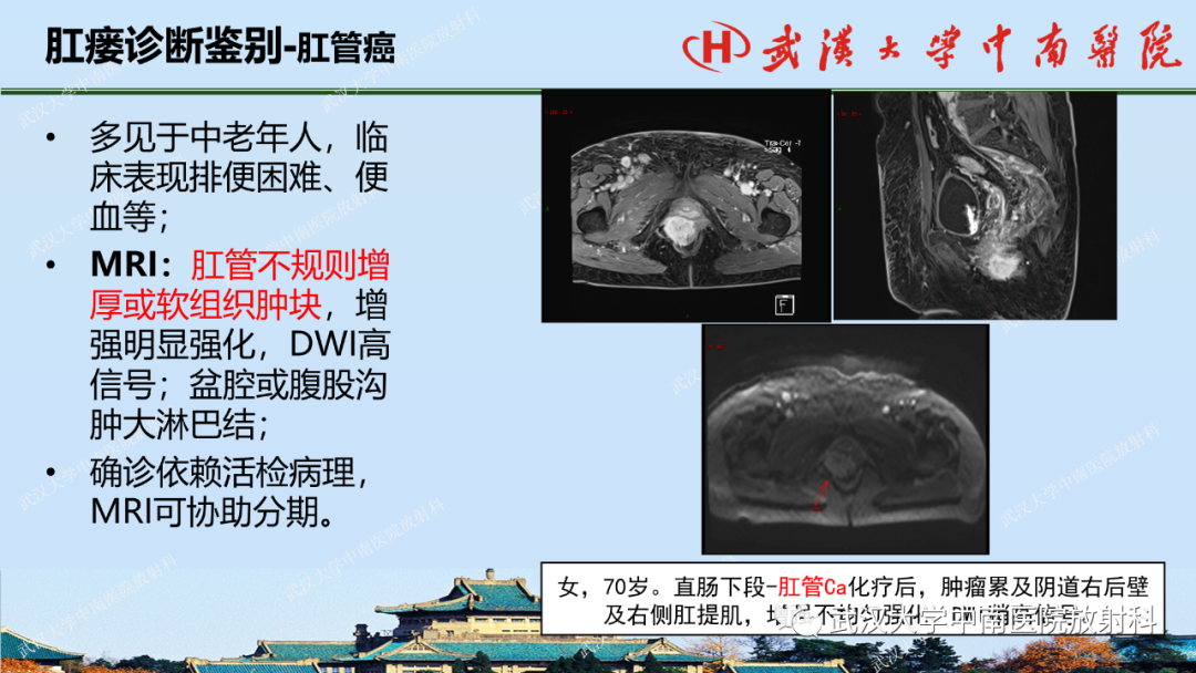 影像PPT - 【PPT】肛瘘及肛周感染病变的影像诊断-33