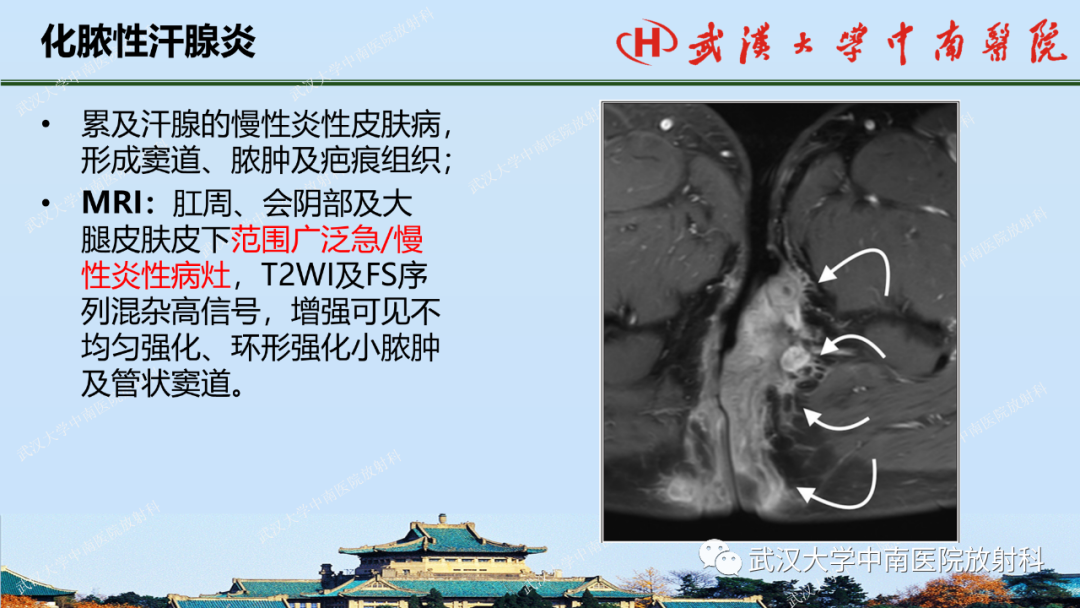 影像PPT - 【PPT】肛瘘及肛周感染病变的影像诊断-35