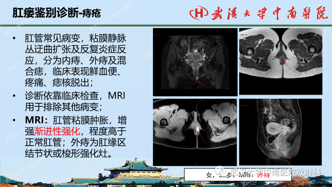 影像PPT - 【PPT】肛瘘及肛周感染病变的影像诊断-32