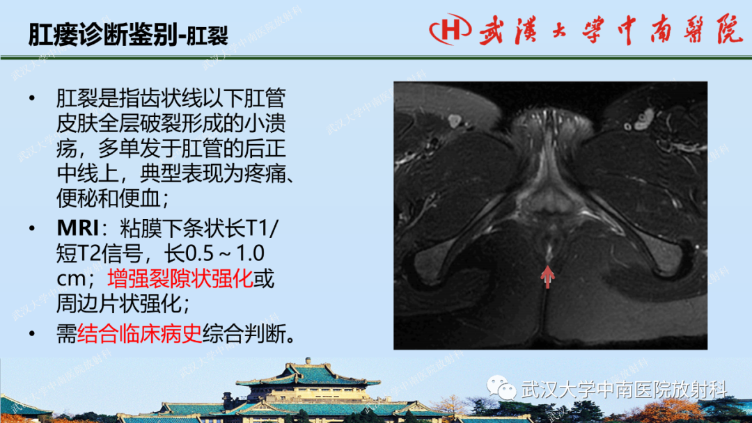 影像PPT - 【PPT】肛瘘及肛周感染病变的影像诊断-31