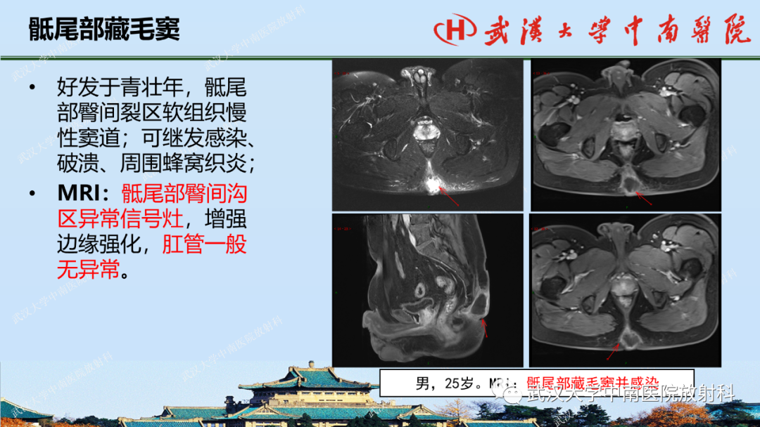 影像PPT - 【PPT】肛瘘及肛周感染病变的影像诊断-38