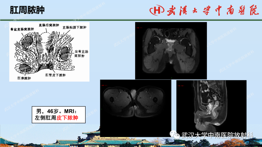 影像PPT - 【PPT】肛瘘及肛周感染病变的影像诊断-36