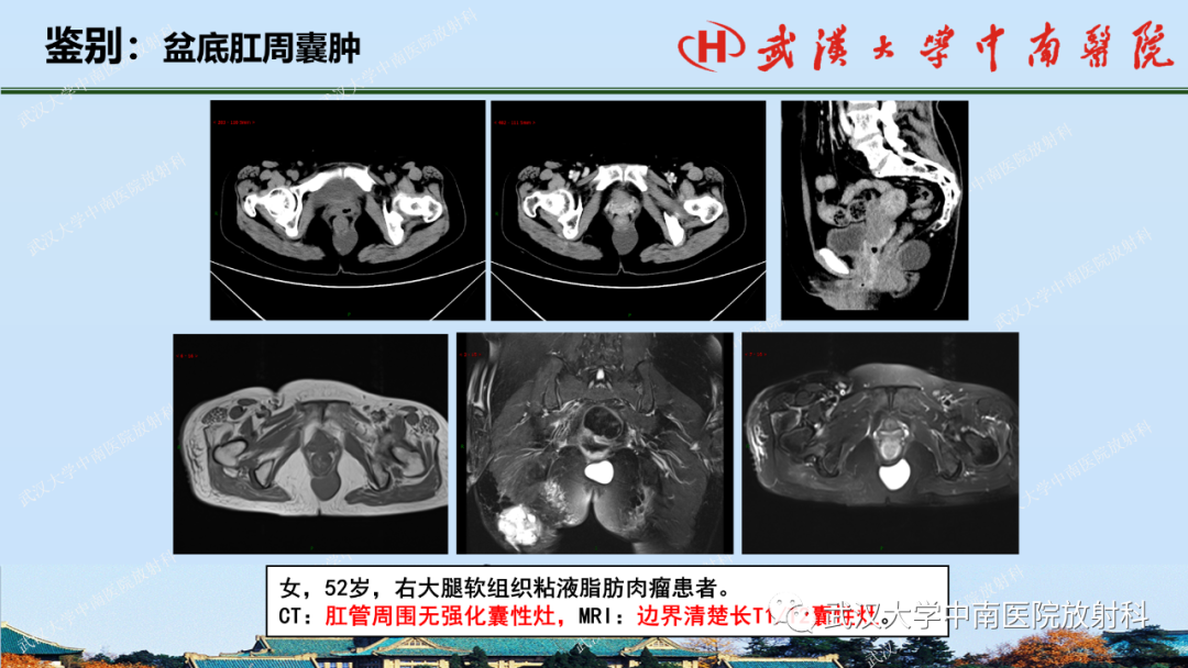 影像PPT - 【PPT】肛瘘及肛周感染病变的影像诊断-37