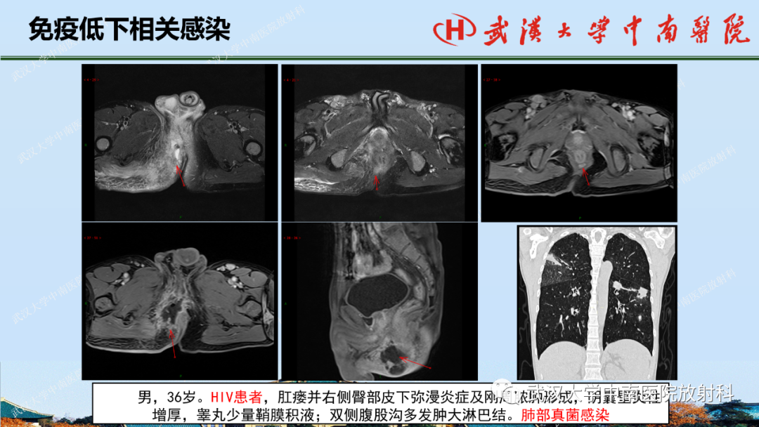 影像PPT - 【PPT】肛瘘及肛周感染病变的影像诊断-39