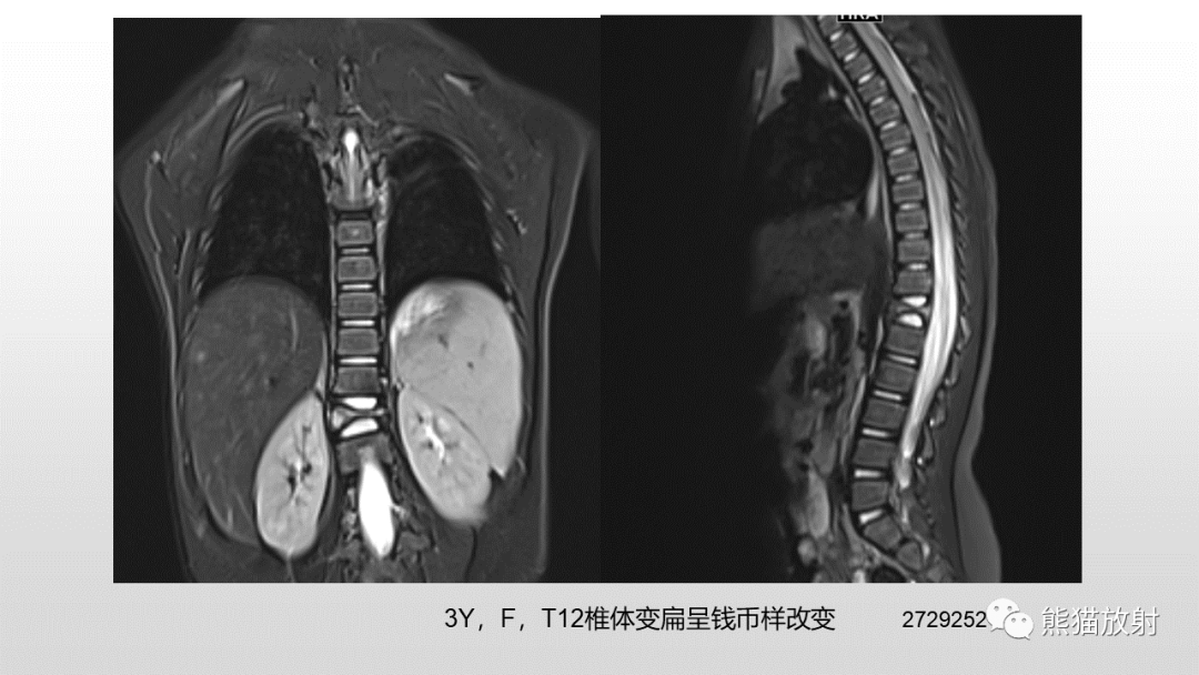 影像PPT - 【病例】胸椎朗格汉斯组织细胞增多症 VS 胸椎结核-28