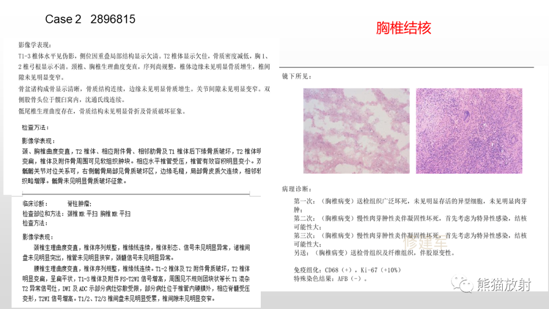 影像PPT - 【病例】胸椎朗格汉斯组织细胞增多症 VS 胸椎结核-24