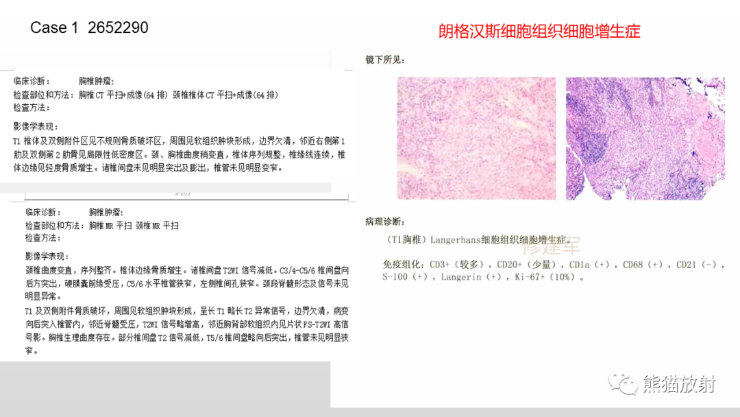 影像PPT - 【病例】胸椎朗格汉斯组织细胞增多症 VS 胸椎结核-23