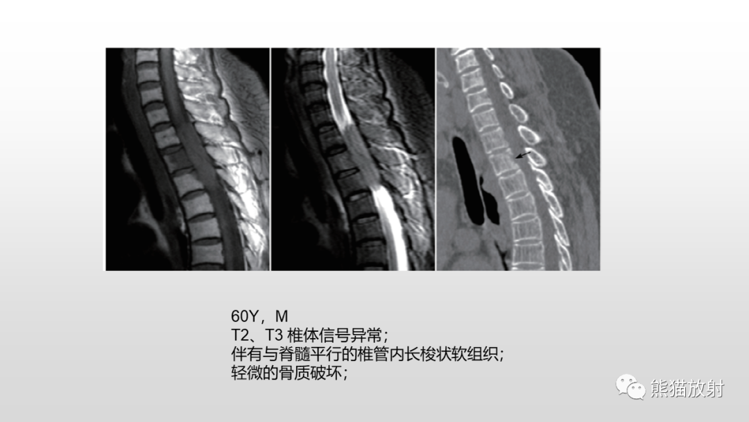 影像PPT - 【病例】胸椎朗格汉斯组织细胞增多症 VS 胸椎结核-34
