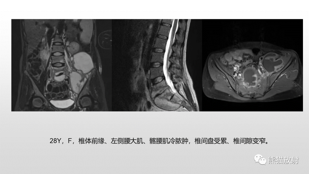 影像PPT - 【病例】胸椎朗格汉斯组织细胞增多症 VS 胸椎结核-30