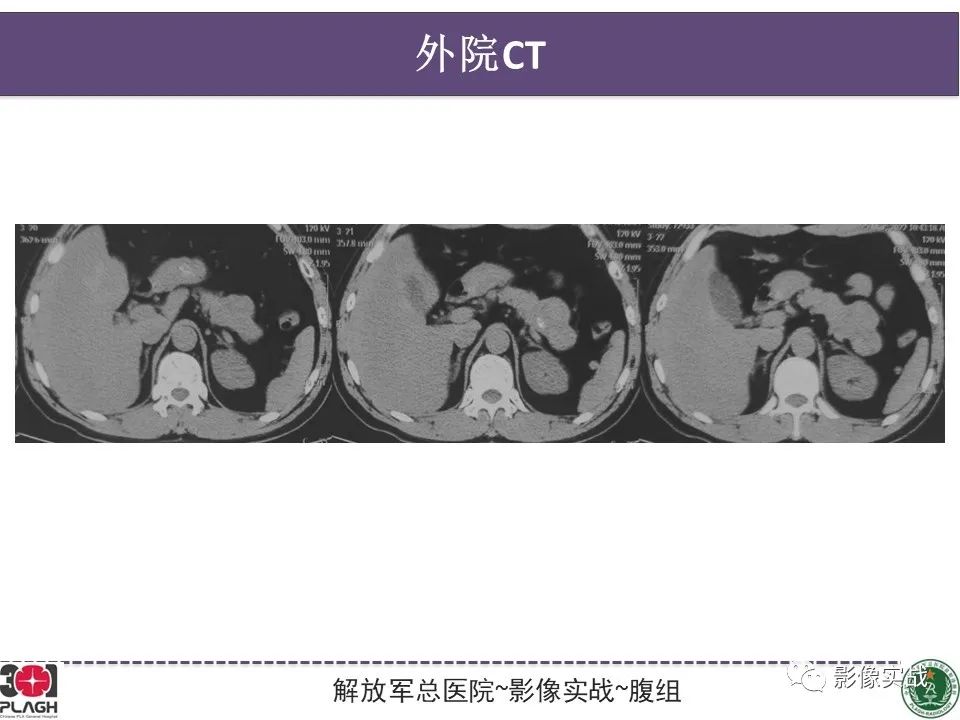 影像PPT - 【病例】胰腺实性假乳头状瘤1例CT及MR影像分析-5