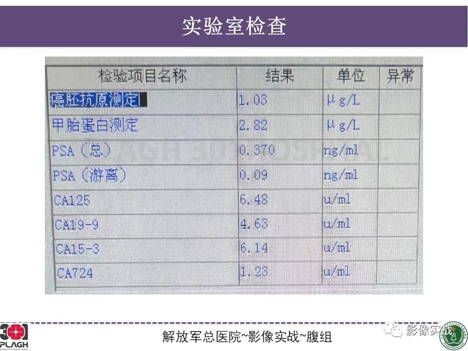 影像PPT - 【病例】胰腺实性假乳头状瘤1例CT及MR影像分析-4