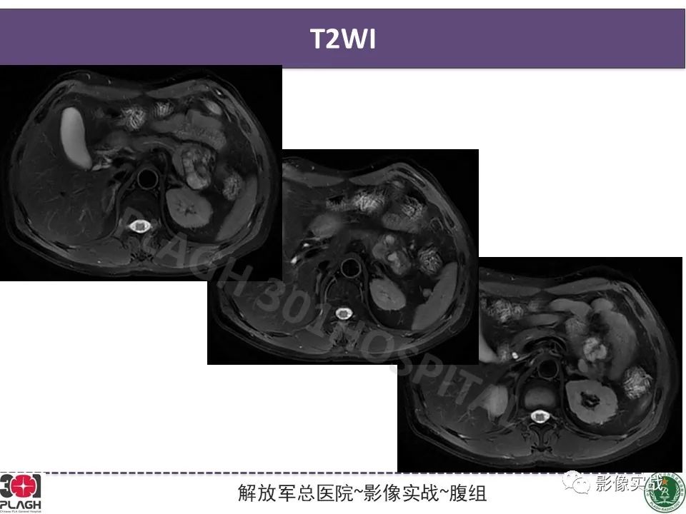 影像PPT - 【病例】胰腺实性假乳头状瘤1例CT及MR影像分析-6