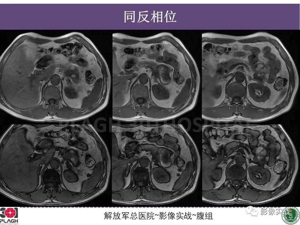 影像PPT - 【病例】胰腺实性假乳头状瘤1例CT及MR影像分析-8
