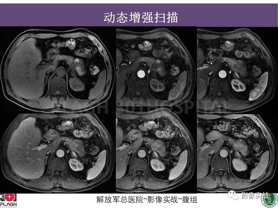 影像PPT - 【病例】胰腺实性假乳头状瘤1例CT及MR影像分析-9