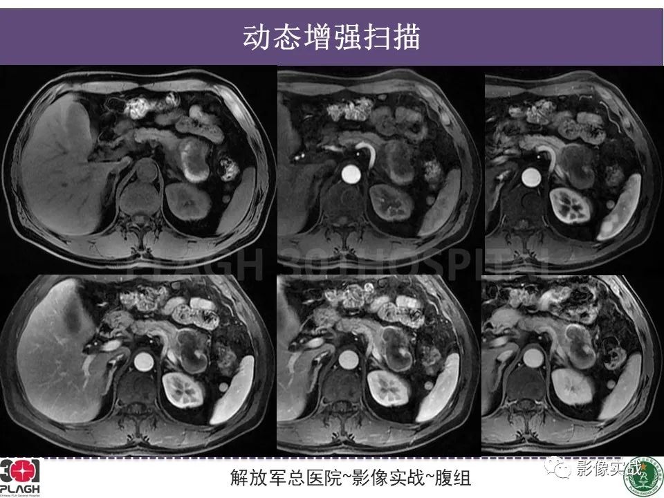 影像PPT - 【病例】胰腺实性假乳头状瘤1例CT及MR影像分析-10