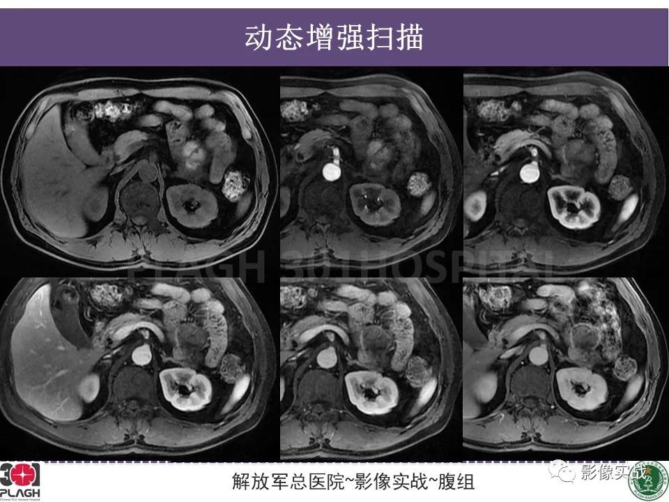 影像PPT - 【病例】胰腺实性假乳头状瘤1例CT及MR影像分析-11