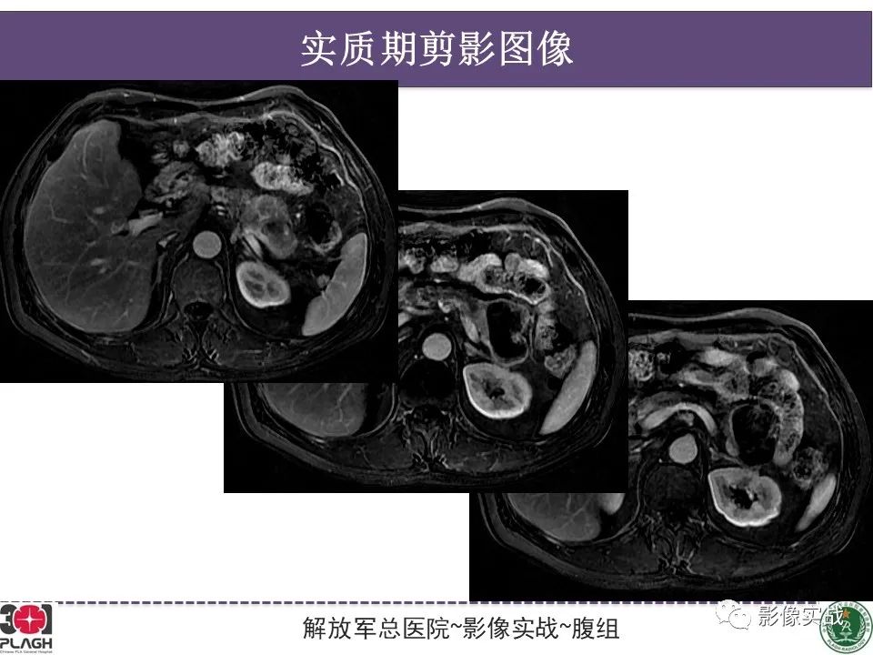 影像PPT - 【病例】胰腺实性假乳头状瘤1例CT及MR影像分析-12