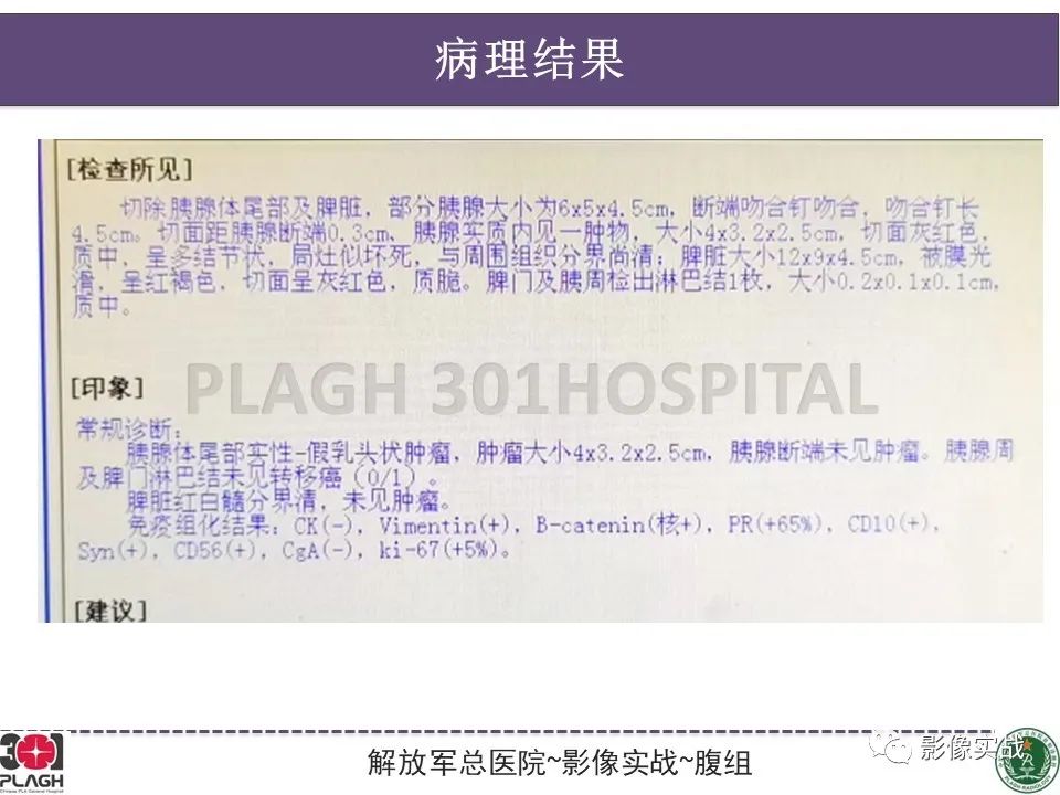 影像PPT - 【病例】胰腺实性假乳头状瘤1例CT及MR影像分析-26