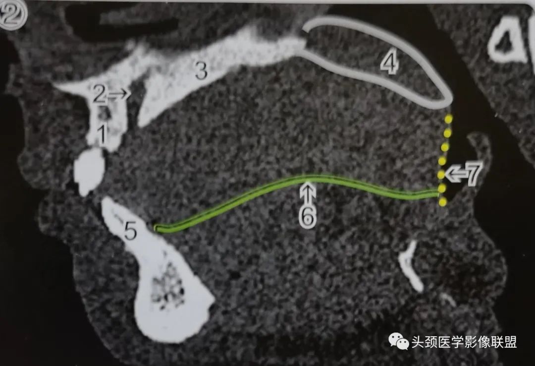 影像PPT - 固有口腔影像解剖-2 影像PPT - 固有口腔影像解剖-2