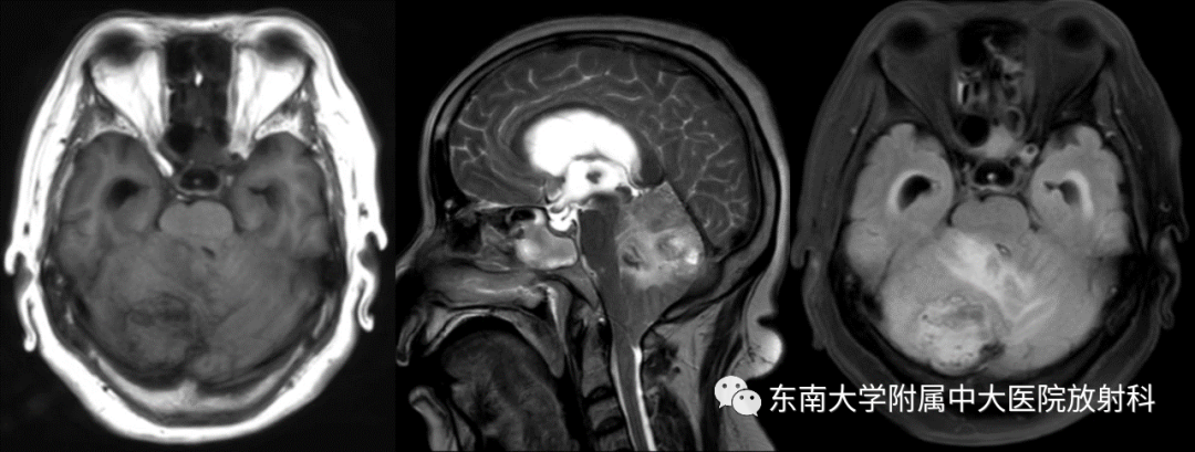 影像PPT - 【PPT】小脑血管母细胞瘤-1