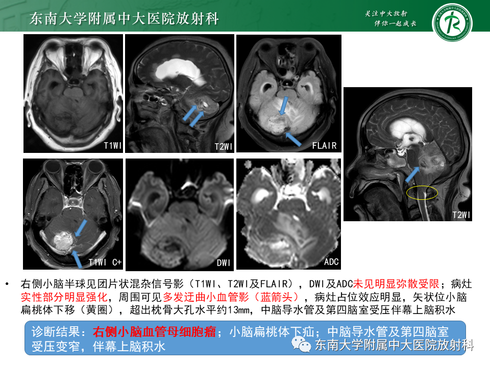 影像PPT - 【PPT】小脑血管母细胞瘤-3