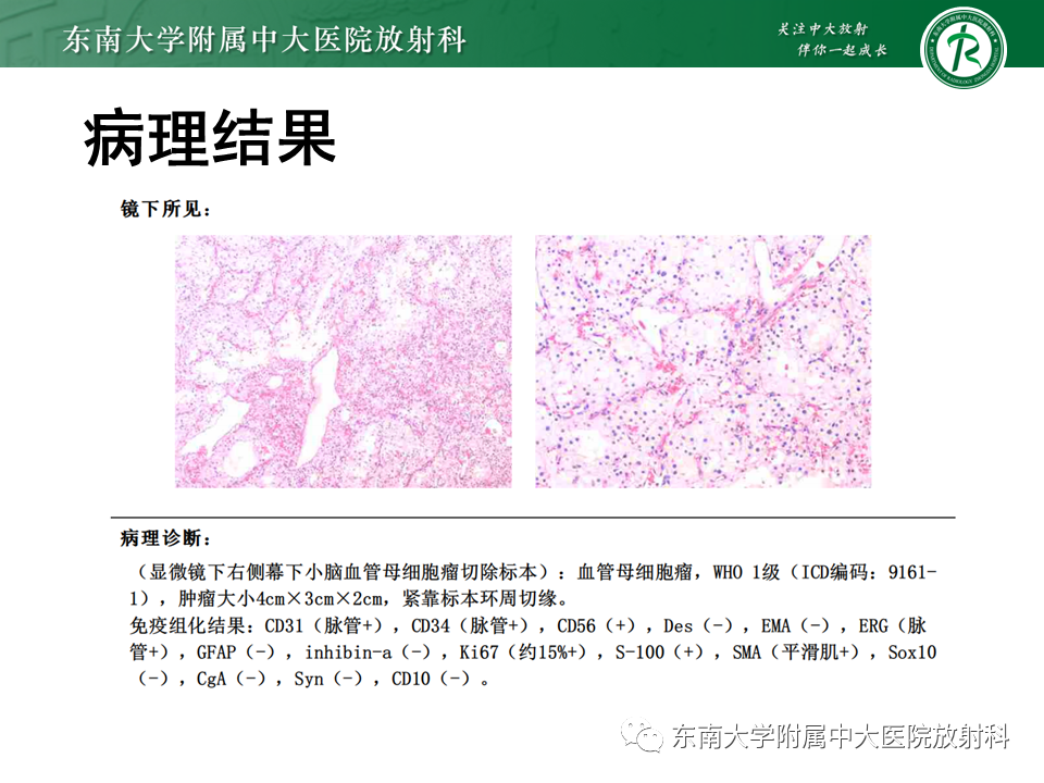 影像PPT - 【PPT】小脑血管母细胞瘤-4