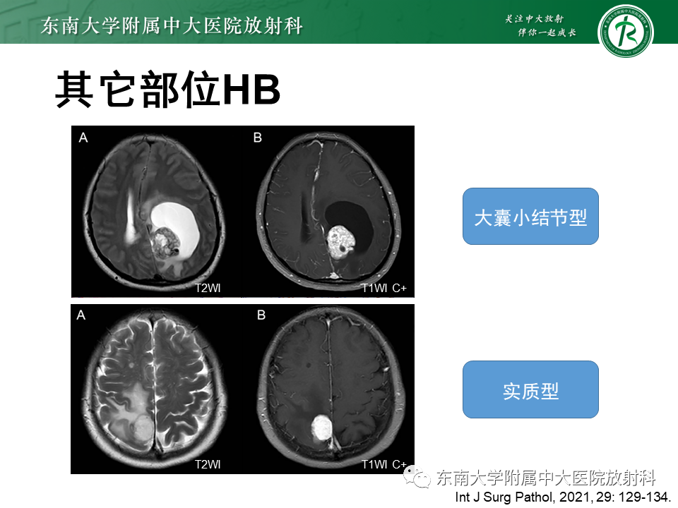 影像PPT - 【PPT】小脑血管母细胞瘤-8
