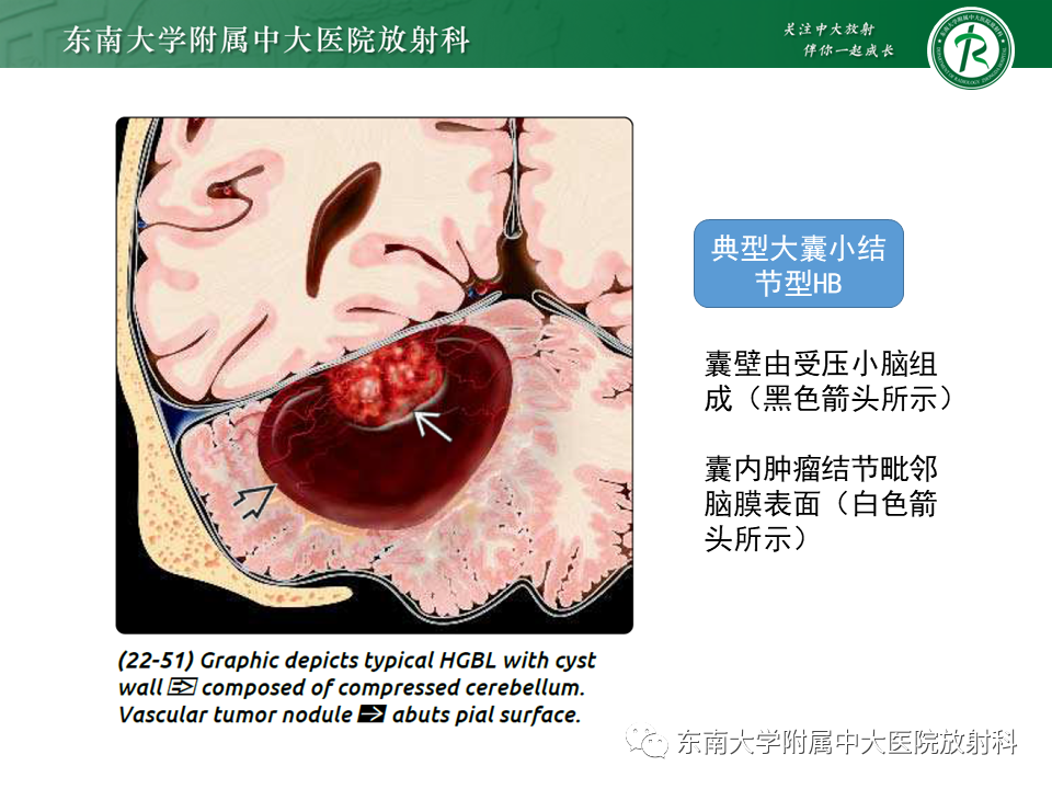 影像PPT - 【PPT】小脑血管母细胞瘤-9