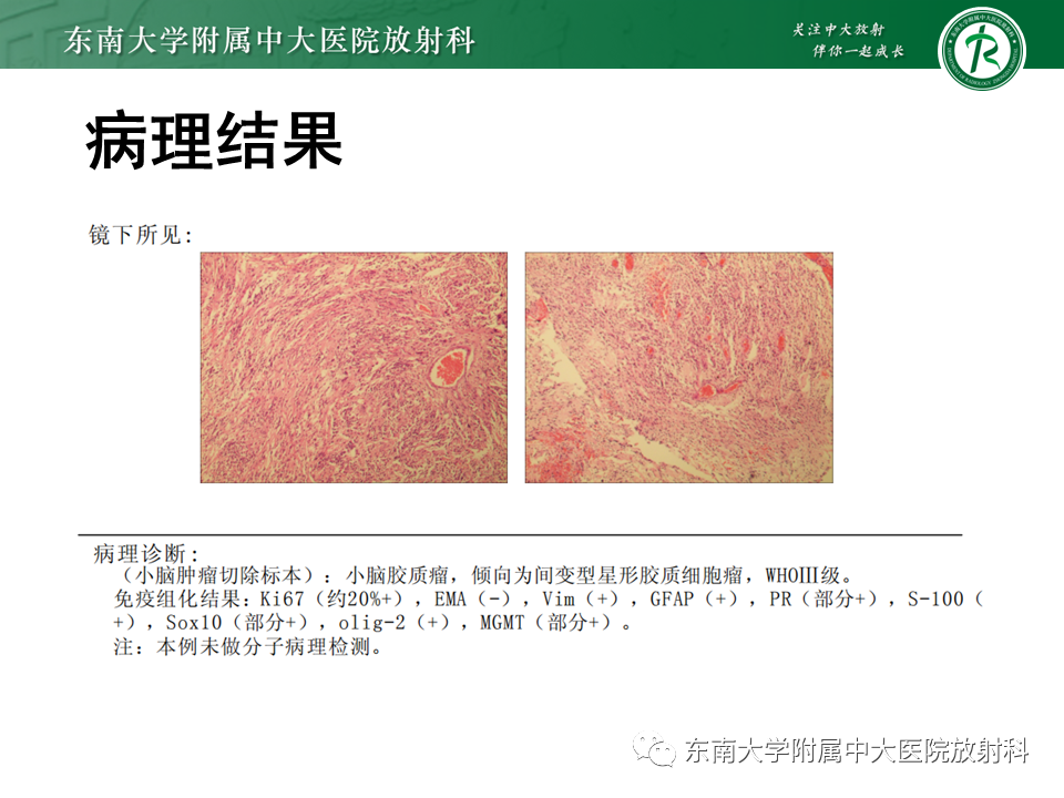 影像PPT - 【PPT】小脑血管母细胞瘤-29