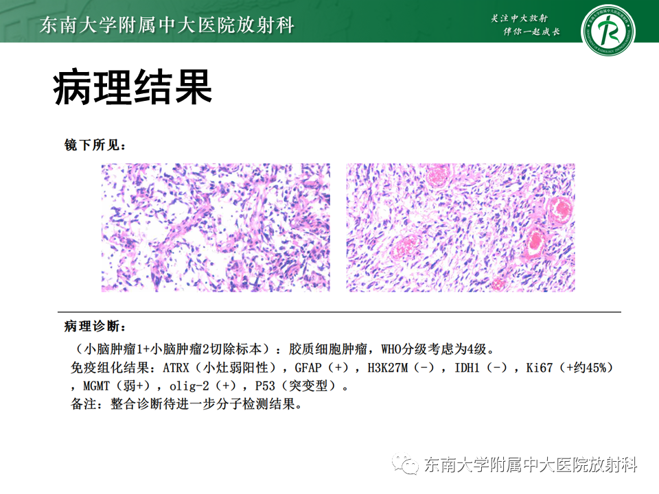 影像PPT - 【PPT】小脑血管母细胞瘤-32