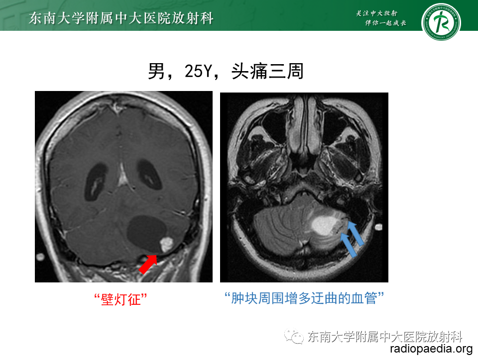 影像PPT - 【PPT】小脑血管母细胞瘤-11